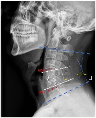 Comparative analysis of risk factors associated with degeneration of adjacent segments: zero-profile anchored spacer vs. anterior cervical plate and cage construct